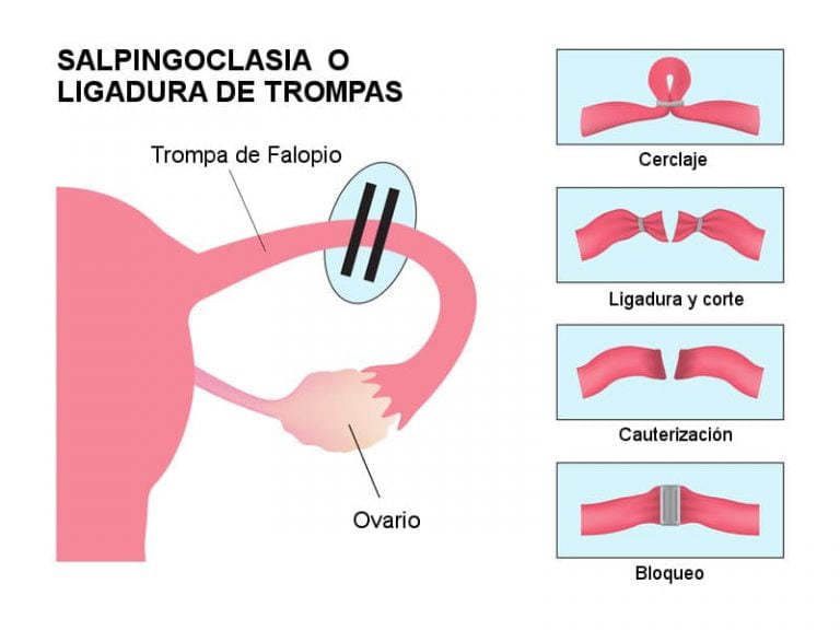 Salpingoclasia qué es, ventajas y desventajas de la ligadura de